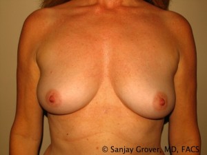 Breast Augmentation Before and After | Grover Aesthetics