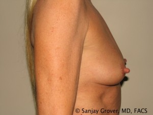Breast Augmentation Before and After 141 | Sanjay Grover MD FACS