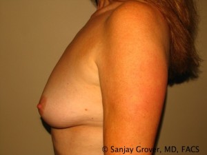 Breast Augmentation Before and After 141 | Grover Aesthetics