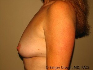 Breast Augmentation Before and After 141 | Sanjay Grover MD FACS