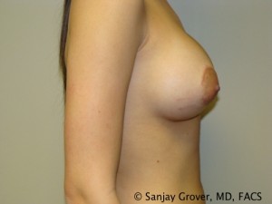 Breast Augmentation Before and After 142 | Grover Aesthetics