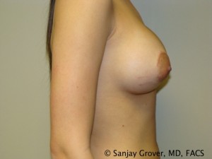 Breast Augmentation Before and After 142 | Sanjay Grover MD FACS