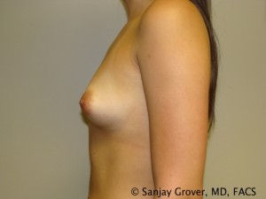 Breast Augmentation Before and After 142 | Grover Aesthetics