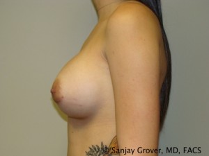 Breast Augmentation Before and After 142 | Grover Aesthetics