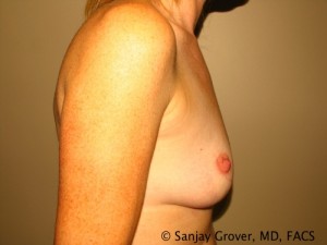 Breast Augmentation Before and After 143 | Grover Aesthetics