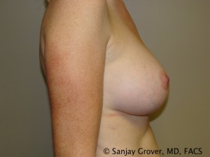 Breast Augmentation Before and After 143 | Grover Aesthetics
