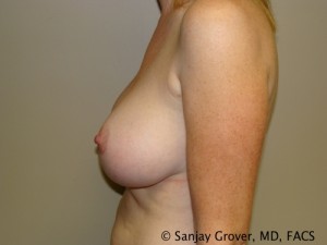 Breast Augmentation Before and After 143 | Grover Aesthetics