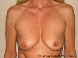 Breast Augmentation Before and After 53 | Sanjay Grover MD FACS