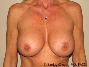 Breast Augmentation Before and After | Sanjay Grover MD FACS