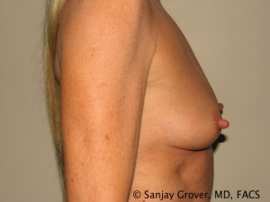 Breast Augmentation Before and After 144 | Grover Aesthetics