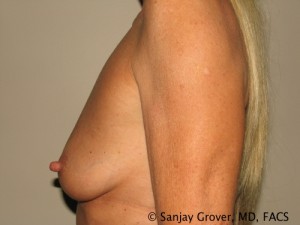 Breast Augmentation Before and After 144 | Grover Aesthetics