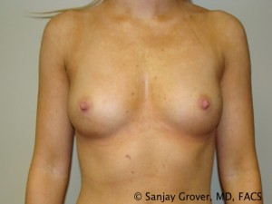 Breast Augmentation Before and After | Grover Aesthetics