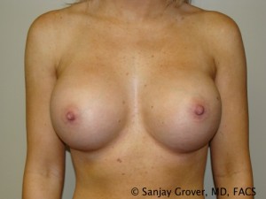 Breast Augmentation Before and After 145 | Sanjay Grover MD FACS