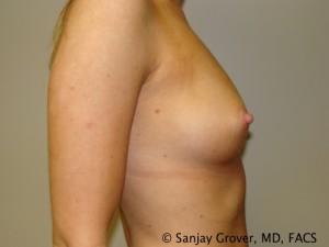 Breast Augmentation Before and After 145 | Grover Aesthetics