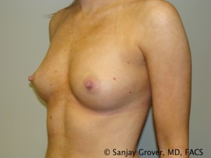 Breast Augmentation Before and After 145 | Sanjay Grover MD FACS