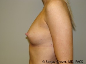 Breast Augmentation Before and After 145 | Grover Aesthetics