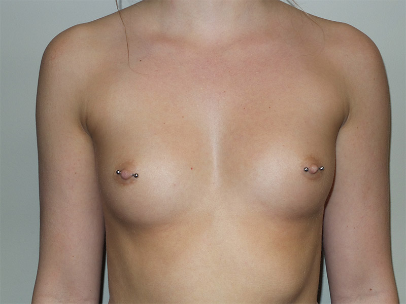 Breast Augmentation Before and After 03 | Sanjay Grover MD FACS