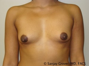 Breast Augmentation Before and After | Grover Aesthetics