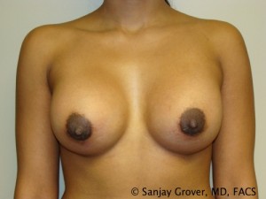 Breast Augmentation Before and After | Grover Aesthetics