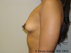 Breast Augmentation Before and After 146 | Grover Aesthetics