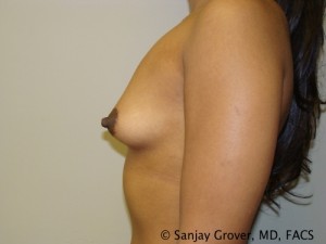 Breast Augmentation Before and After 146 | Sanjay Grover MD FACS