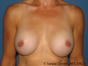Breast Augmentation Before and After 147 | Sanjay Grover MD FACS
