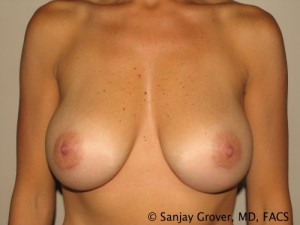 Breast Augmentation Before and After 147 | Sanjay Grover MD FACS