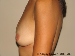 Breast Augmentation Before and After 147 | Grover Aesthetics
