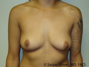 Breast Augmentation Before and After | Sanjay Grover MD FACS