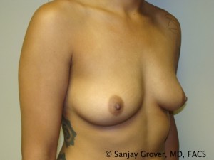 Breast Augmentation Before and After 148 | Sanjay Grover MD FACS