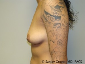 Breast Augmentation Before and After 148 | Grover Aesthetics
