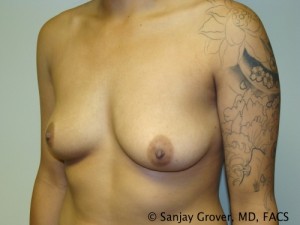 Breast Augmentation Before and After 148 | Grover Aesthetics