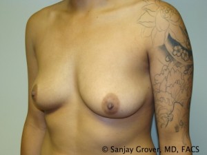 Breast Augmentation Before and After 148 | Sanjay Grover MD FACS