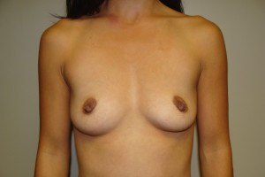 Breast Augmentation Before and After 53 | Sanjay Grover MD FACS