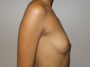 Breast Augmentation Before and After 15 | Sanjay Grover MD FACS
