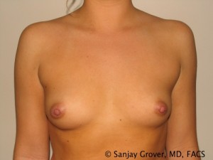 Breast Augmentation Before and After 294 | Sanjay Grover MD FACS
