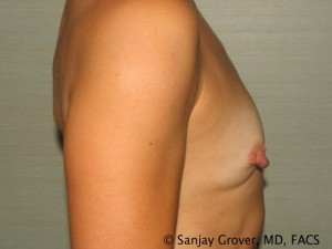 Breast Augmentation Before and After 150 | Grover Aesthetics