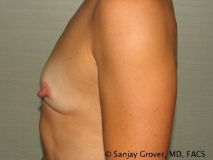 Breast Augmentation Before and After 150 | Grover Aesthetics