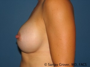 Breast Augmentation Before and After 150 | Grover Aesthetics