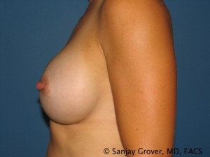 Breast Augmentation Before and After 150 | Sanjay Grover MD FACS