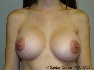 Breast Augmentation Before and After 151 | Sanjay Grover MD FACS