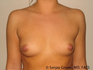 Breast Augmentation Before and After 78 | Sanjay Grover MD FACS