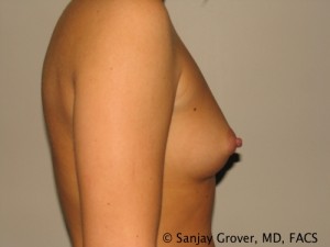 Breast Augmentation Before and After 153 | Grover Aesthetics