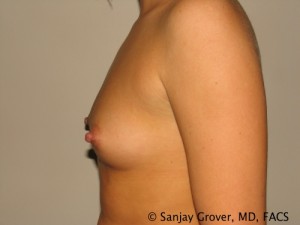 Breast Augmentation Before and After 153 | Grover Aesthetics