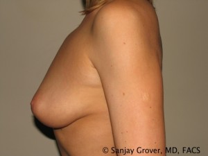 Breast Augmentation Before and After 154 | Grover Aesthetics
