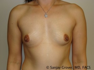 Breast Augmentation Before and After | Grover Aesthetics