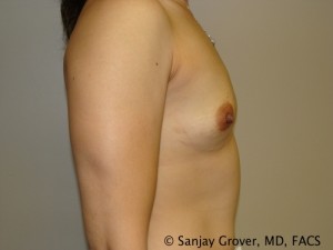 Breast Augmentation Before and After 155 | Sanjay Grover MD FACS