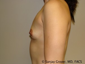 Breast Augmentation Before and After 155 | Grover Aesthetics