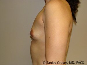 Breast Augmentation Before and After 155 | Sanjay Grover MD FACS