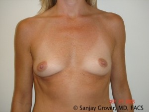 Breast Augmentation Before and After 233 | Sanjay Grover MD FACS
